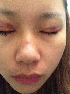 埋线双眼皮闪亮闪亮大眼睛超迷人