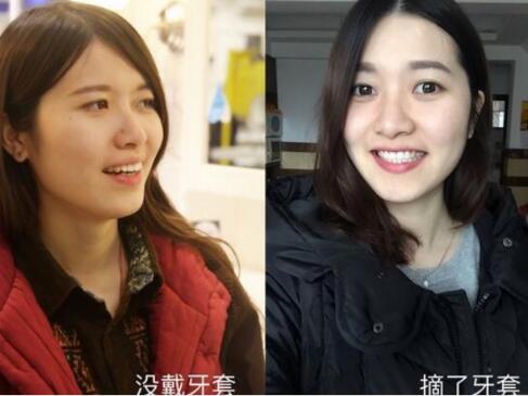 成都牙齿矫正前后对比图分享成都格林口腔