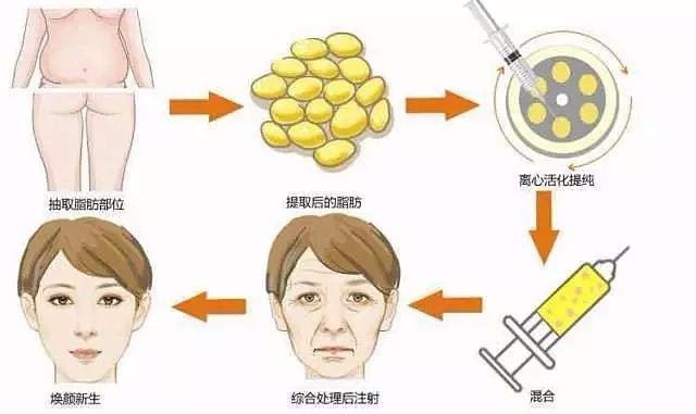 做自体脂肪移植填充可以维持多久时间，怎么提高脂肪存活率