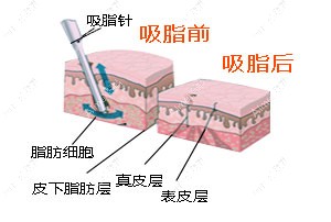 抽脂前后对比