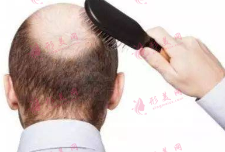 植发为什么这么贵?植好的新头发还会再掉吗？