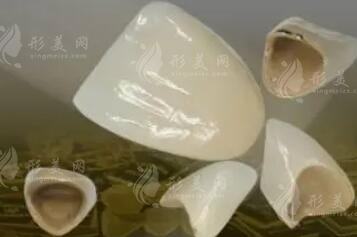 烤瓷牙价格和种类有哪些？哪种效果比较好？科普知识一览