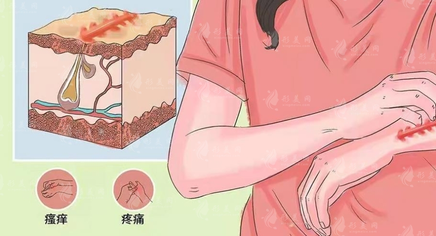 上海九院疤痕整形的案例介绍