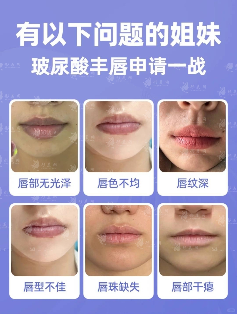 北京玻尿酸丰唇价格多少：4230~16850元起