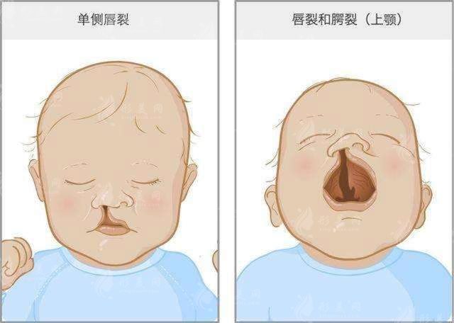 兔唇二次修复哪些医院好？兔唇可以完全无痕迹的修复吗