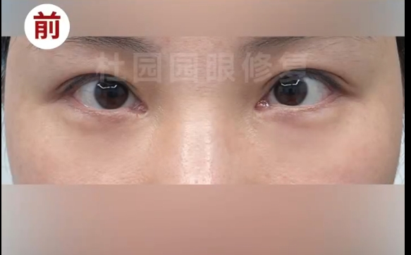 解密内眼角圆形洞修复的奥秘：杜园园医生的精湛技术