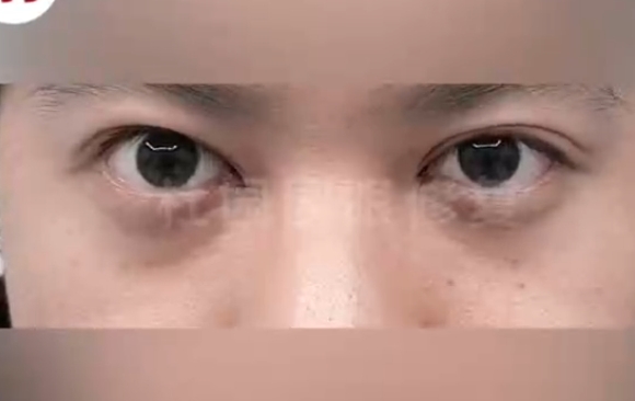 告别窄小双眼，杜园园医生帮你实现双眼变美