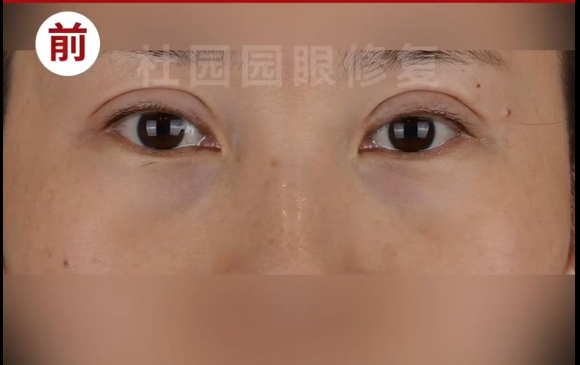 杜园园医生修复案例：双眼皮不去皮，宽降窄，恢复自信