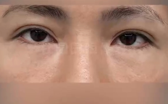 重塑独特魅力：上海爱尚丽格打造惊艳人造双眼皮