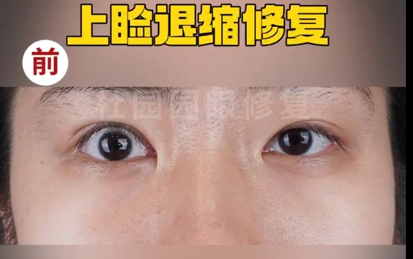 上睑下垂失败不再困扰！上海爱尚丽格专家带您寻找解决方案