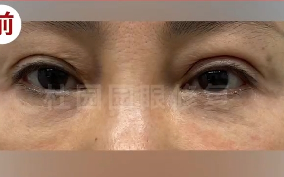 双眼皮注射脂肪失败再修复，杜园园医生案例分享