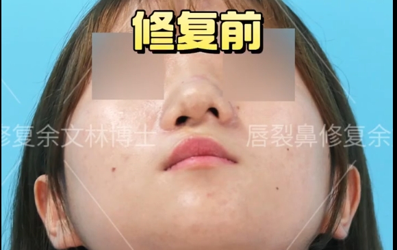 唇裂鼻修复：选择合适的方法成就完美笑容