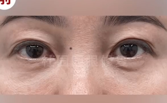 重塑双眼魅力，上海爱尚丽格医院双眼皮多重褶皱修复解决方案
