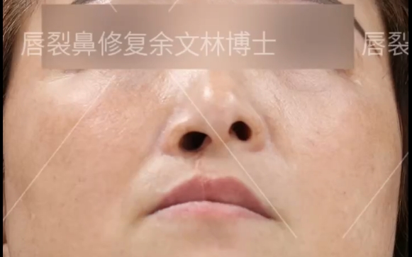 唇裂修复后，鼻子为什么还是歪的？余文林医生详解