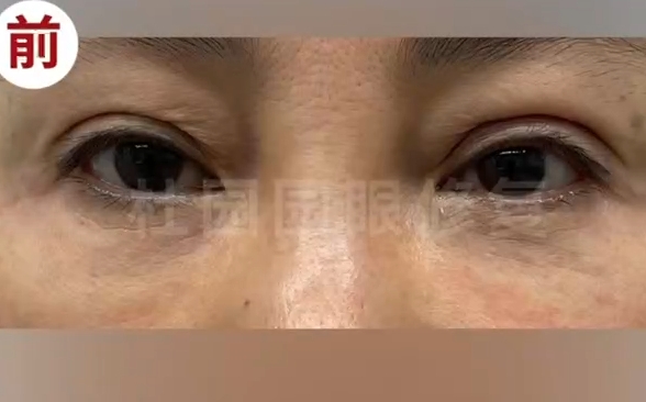 双眼皮注射脂肪失败怎么办？跟随杜园园医生修复再次美丽