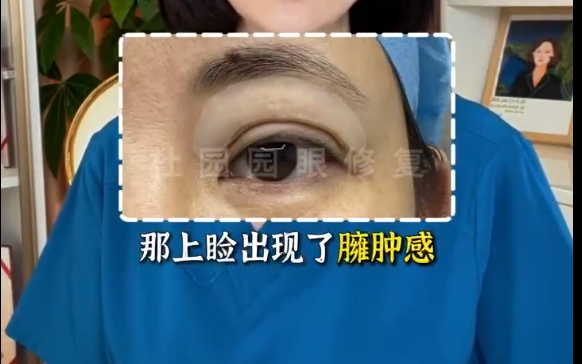 揭秘上眼睑脂肪注射不满意的真相！上海爱尚丽格专家解答你为什么