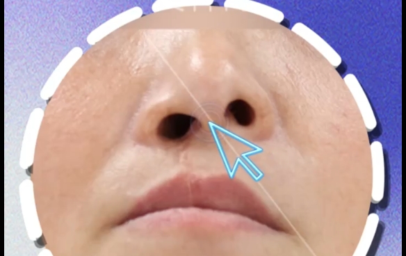 患侧vs健侧鼻孔大，哪种更好修复？余文林医生分析