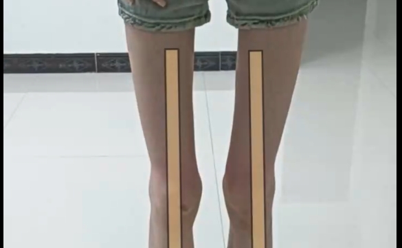 程辰医生揭秘：酒杯腿与筷子腿，如何选择？ 