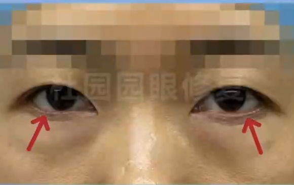 疤痕痕迹不再困扰！上海爱尚丽格眼袋术后睑缘恢复专家