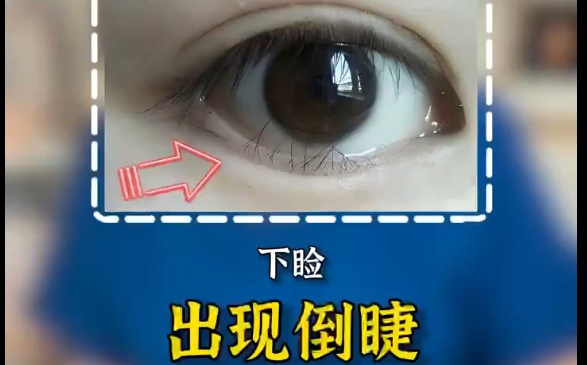 为何做完外眼角下至会产生倒睫现象？上海爱尚丽格专家解答