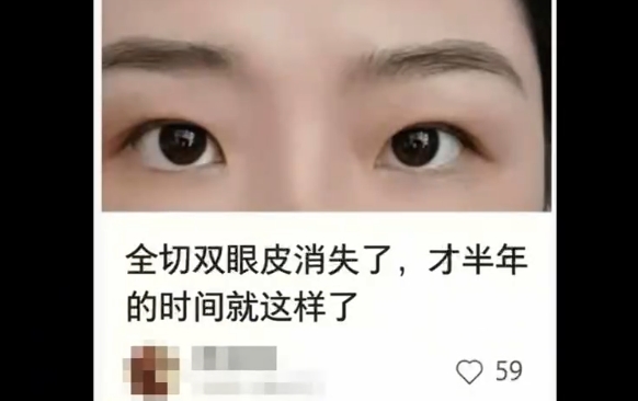 双眼皮术后：近期效果 vs. 远期效果，杜园园医生解析