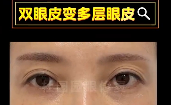 多层双眼皮成因解答：杜园园医生分享专业观点