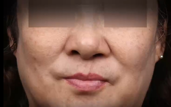 62岁第一次做唇裂修复，余文林医生案例分享