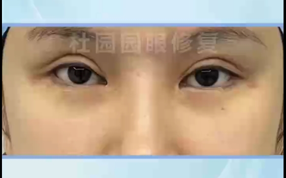 杜园园医生亲授双眼皮新月型改善秘笈，让你眼神闪亮 