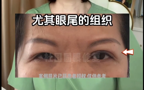 双眼皮线条过长困扰？上海爱尚丽格医院线条修复专家帮你