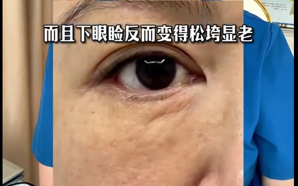 探究眼袋术后下睑松垮的真正原因，杜圆圆医生详细解析 