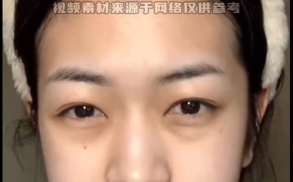 魏皎医生揭秘：普通人的泪沟改善策略，让你眼神焕发青春