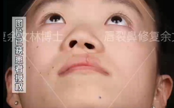 小时候的唇裂没修复好会变成怎样？余文林医生解析