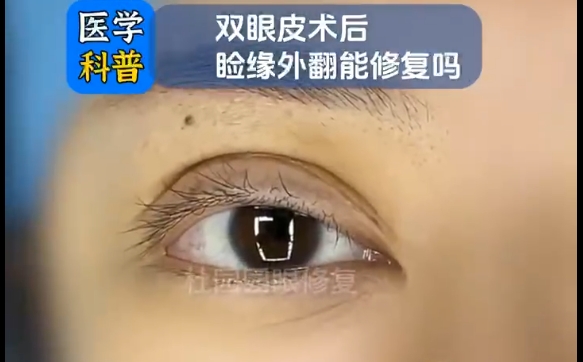 杜园园医生分享：双眼皮术后睑缘外翻有解决办法吗？
