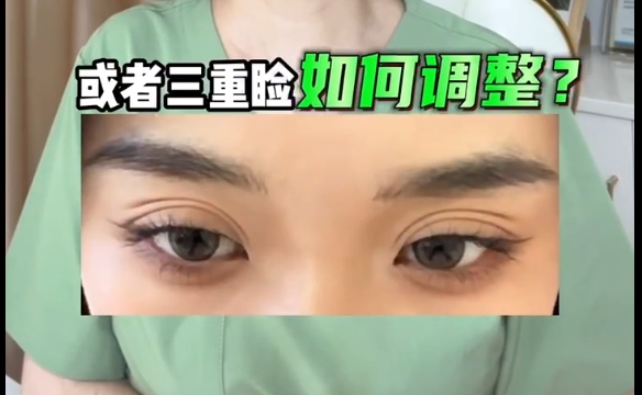 双眼皮术后多重睑困扰？杜园园医生揭秘调整技巧