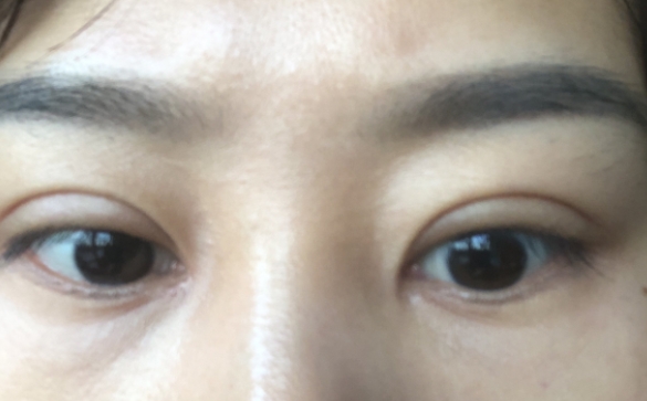 双眼皮深如何修复，降窄能解决问题吗？杜园园医生回答你