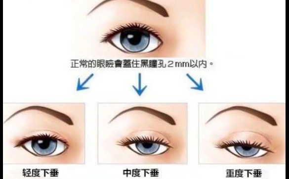 上睑下垂是全麻吗？怎么配合？周显玉医生解答