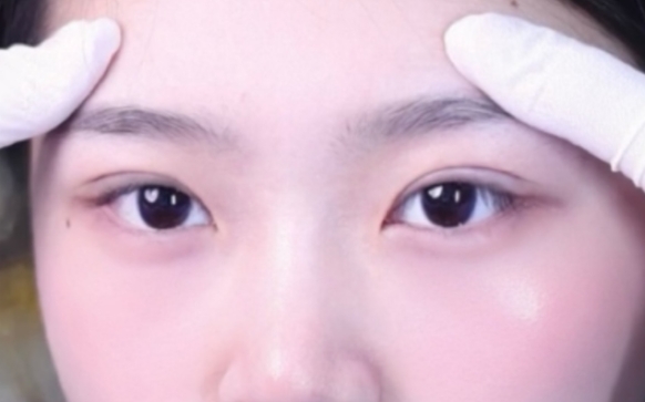 双眼皮手术：如何打造开扇双眼皮？周显玉医生案例分享