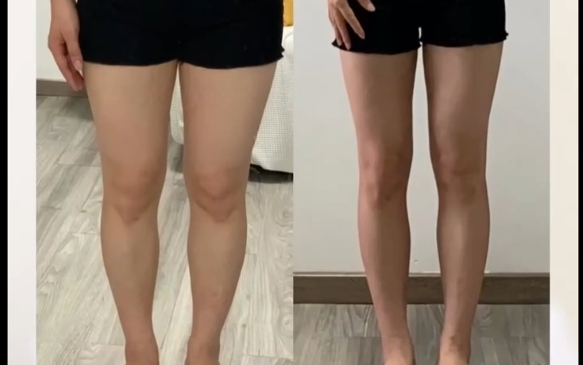 吸脂从胖到瘦的几个阶段，程辰医生在线解析