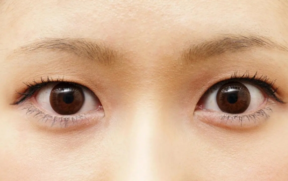 上睑下垂是否能一次到位？周显玉医生解答