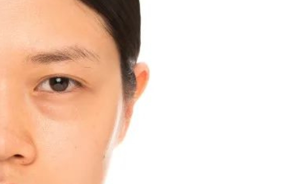 改善眼袋泪沟，为什么推荐眶隔脂肪释放？周显玉医生告诉你