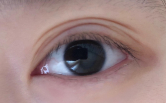 双眼皮术后出现多层双眼皮是什么情况？