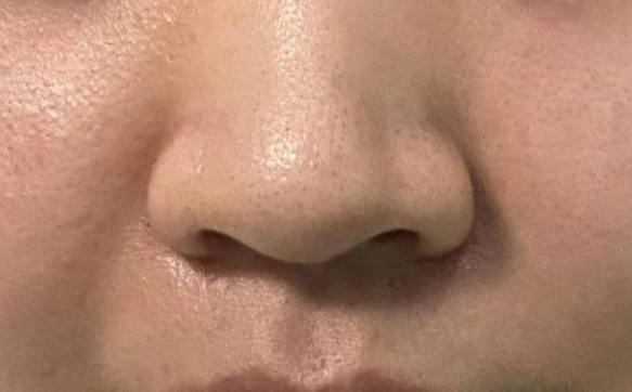 千万不要外切你的鼻翼，让你的鼻头自然缩小