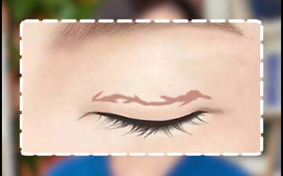 双眼皮疤痕严重，唯二可以去皮的情况。杜圆圆医生告诉你