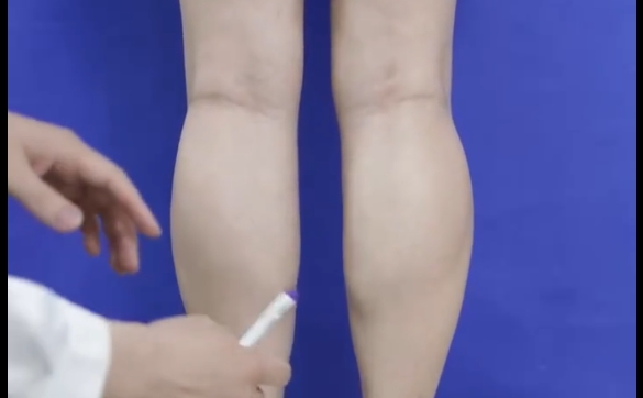 瘦腿针？吸脂？到底哪个方式可以改善小腿粗？