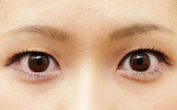 所有上睑下垂都会遗传吗？周显玉医生为你解答