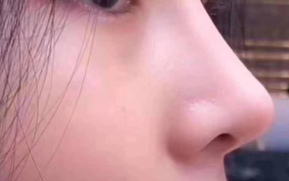 鼻背长痘一直没有消，医生：别扣了，线穿出来了！