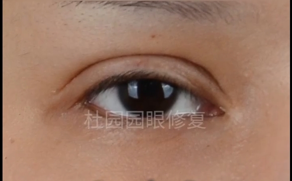 中重度上睑下垂修复后，还会复发？杜园园医生为你解答