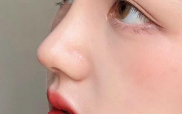 初鼻为什么不做肋软骨？魏皎医生告诉你