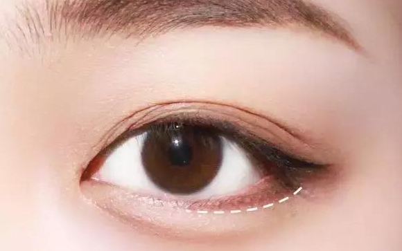 微创手术做出来的卧蚕是永久的吗？