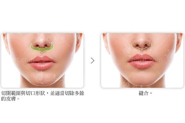 人中缩短术六个月效果图对比 人中缩短术六个月效果图对比